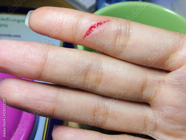 Obraz Closeup view, index finger on right hand is cut hurt and bleedin