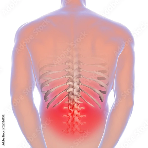 Fototapeta Sciatica - lower back pain