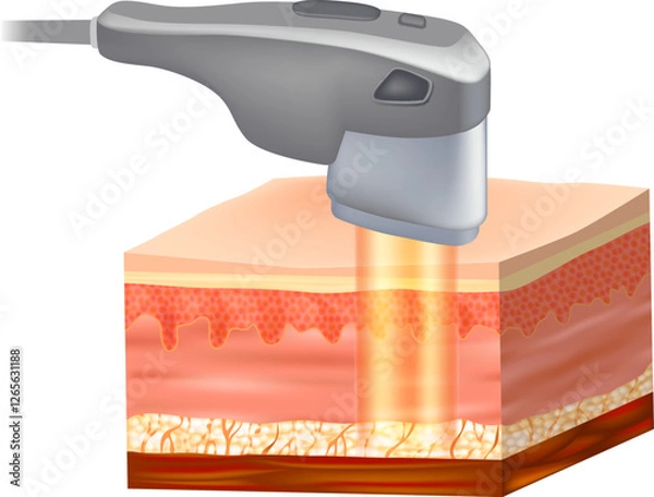 Obraz Ultrasonic SMAS lifting or HIFU lifting. Gold Laser Procedure. Ultrasound Skin Tightening and Anti-Aging Technology. Deep Tissue Skin Rejuvenation