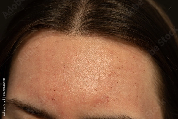 Fototapeta Close-up of skin after laser resurfacing – CO2 fractionated laser.