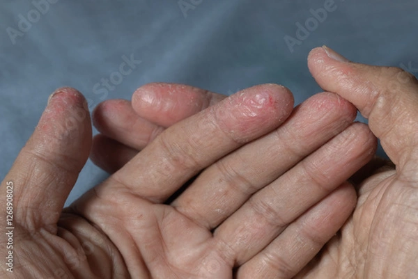 Fototapeta Fingers of a patient with atopic dermatitis after prolonged exposure to alkaline chemicals. Inflamed skin for health care and medical background.