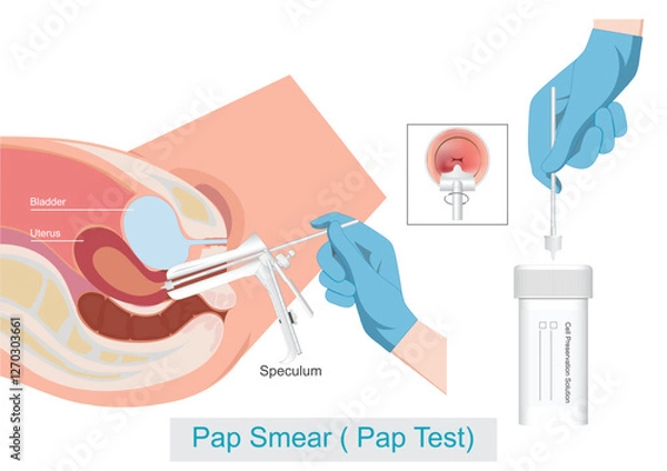 Obraz Pap Smear Cervical Cancer Screening.