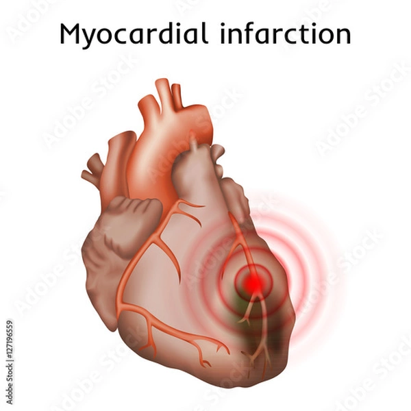 Fototapeta Myocardial infarction. Heart attack, pain. Damaged heart muscle. Anatomy illustration. Red image, white background.