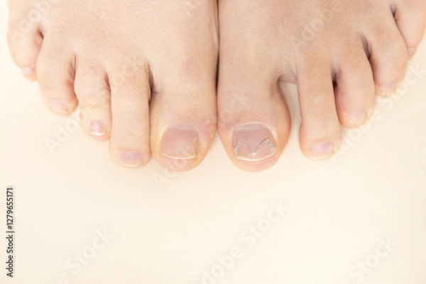 Fototapeta 2 feet, view from above, ingrown nail with podofix system. View from above, close-up