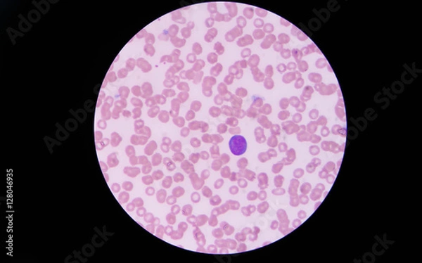 Obraz Atypical lymphocyte