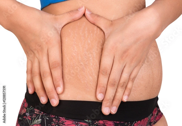 Fototapeta stretch marks