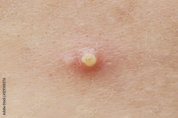 Fototapeta acne macro, pimple closeup