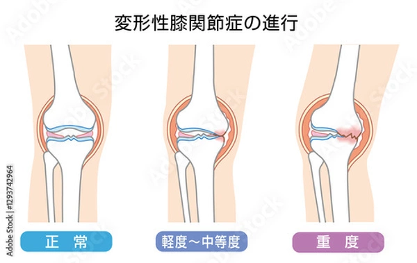 Fototapeta 変形性膝関節症の進行を表したイラスト