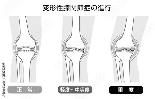 Fototapeta 変形性膝関節症の進行を表したモノトーンのイラスト
