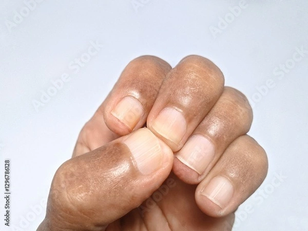 Fototapeta A close-up photo of a fingernail reveals a yellow tint and vertical lines, potentially caused by aging, anemia, vitamin B12 deficiency, underlying health conditions, or other factors