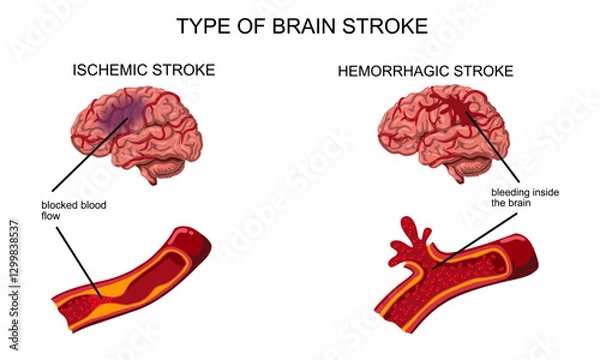 Fototapeta Brain stroke, hemorrhagic and ischemic. Arteriosclerosis, infarct, ischemia, thrombosis disease. Cholesterol in human blood vessels. Medical poster vector illustration.