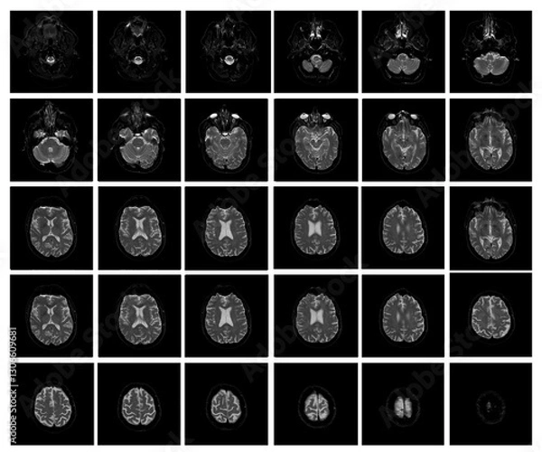 Obraz 1 of the 12 Magnetic Resonance images series of a 67yo man.  MRI brain and brainstem: axial, coronal, and sagittal plane imaging with T1, T2, FLAIR, DWI, T2* sequences. Other images in the portfolio.