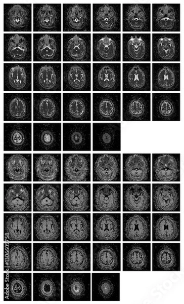Obraz 1 of the 12 Magnetic Resonance images series of a 67yo man.  MRI brain and brainstem: axial, coronal, and sagittal plane imaging with T1, T2, FLAIR, DWI, T2* sequences. Other images in the portfolio.