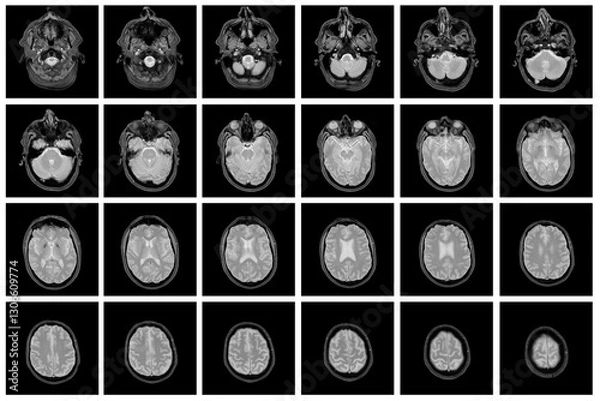 Obraz 1 of the 12 Magnetic Resonance images series of a 67yo man.  MRI brain and brainstem: axial, coronal, and sagittal plane imaging with T1, T2, FLAIR, DWI, T2* sequences. Other images in the portfolio.