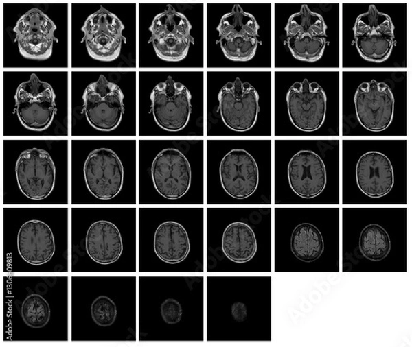 Obraz 1 of the 12 Magnetic Resonance images series of a 67yo man.  MRI brain and brainstem: axial, coronal, and sagittal plane imaging with T1, T2, FLAIR, DWI, T2* sequences. Other images in the portfolio.