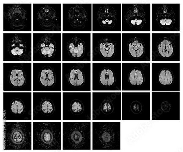Obraz 1 of the 12 Magnetic Resonance images series of a 67yo man.  MRI brain and brainstem: axial, coronal, and sagittal plane imaging with T1, T2, FLAIR, DWI, T2* sequences. Other images in the portfolio.