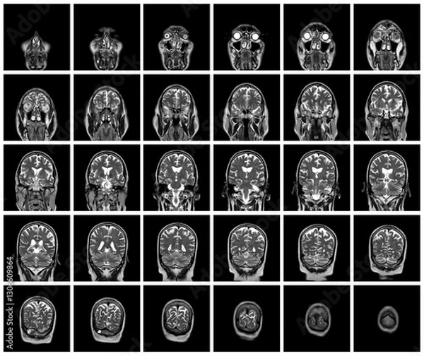 Obraz 1 of the 12 Magnetic Resonance images series of a 67yo man.  MRI brain and brainstem: axial, coronal, and sagittal plane imaging with T1, T2, FLAIR, DWI, T2* sequences. Other images in the portfolio.