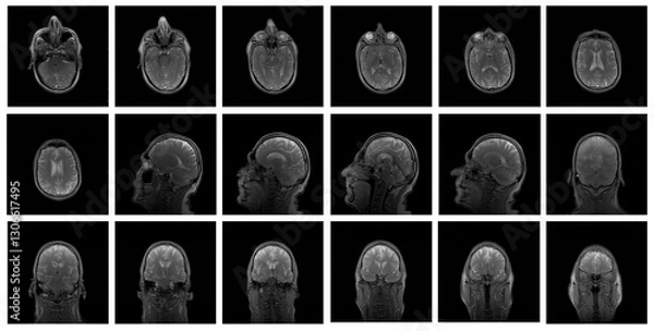 Obraz 1 of the 12 Magnetic Resonance images series of a 67yo man.  MRI brain and brainstem: axial, coronal, and sagittal plane imaging with T1, T2, FLAIR, DWI, T2* sequences. Other images in the portfolio.
