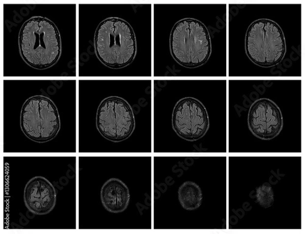 Obraz 1 of the 12 Magnetic Resonance images series of a 67yo man.  MRI brain and brainstem: axial, coronal, and sagittal plane imaging with T1, T2, FLAIR, DWI, T2* sequences. Other images in the portfolio.