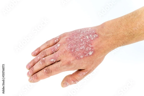 Fototapeta psoriasis on the hand isolated on white