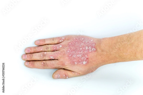 Fototapeta psoriasis on the hand isolated on white