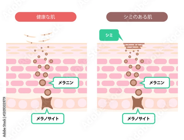 Fototapeta 肌断面図で見せるシミのイラスト