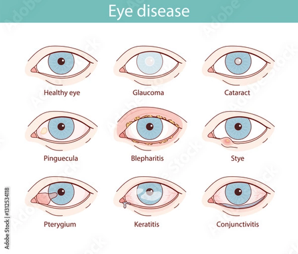 Fototapeta set of illustrations of eyes with different diseases. vector anatomical illustration