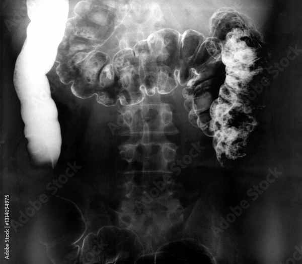 Obraz Real Barium enema images series. Three x-ray of the Lower gastrointestinal (GI) tract. Third special Radiography films of a man large intestine. (The first and second film in the portfolio).
