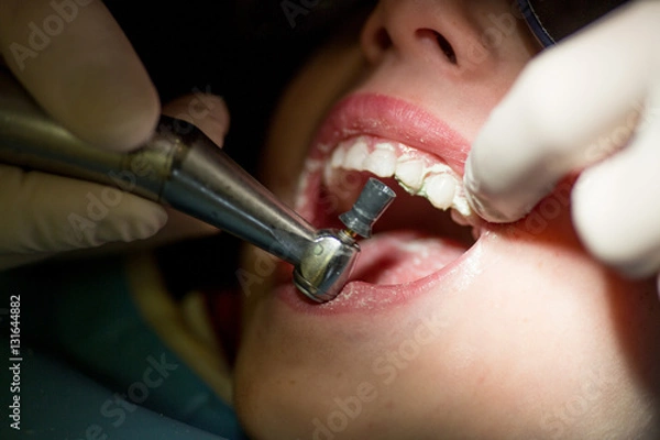 Obraz Teeth polishing procedure, dentistry