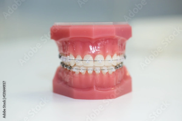Obraz Orthodontic Model, Clear Brace