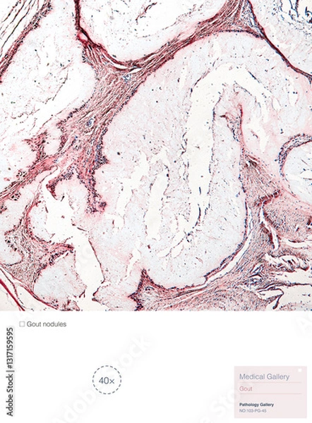 Fototapeta This is a pathological photo of a human gout nodule, showing the formation of pink amorphous eosinophilic substances by urate crystals.Magnify 40x.
