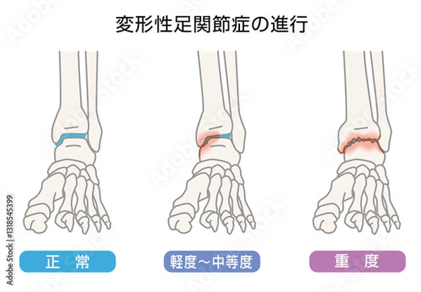 Obraz 変形性足関節症の進行　イラスト