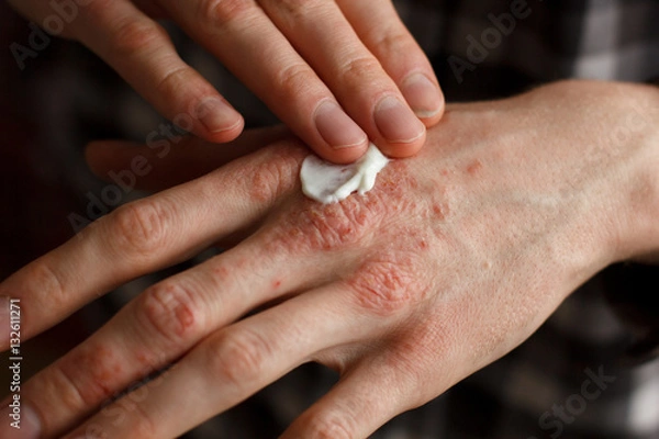 Fototapeta applying an emollient to dry flaky skin as in the treatment of psoriasis, eczema and other dry skin conditions