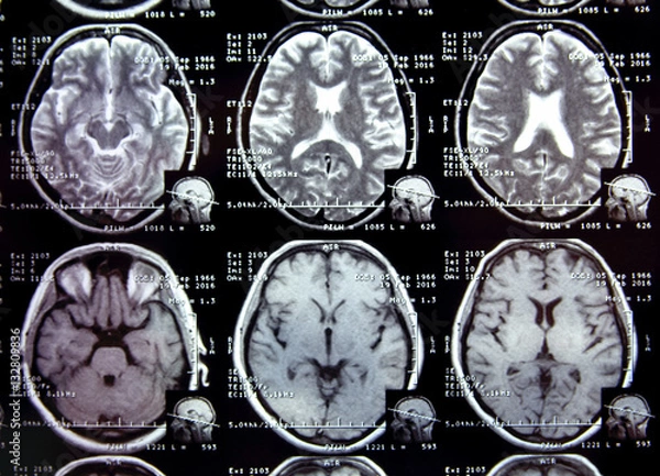 Fototapeta Closeup view of a MRI head scan with brain and skull on it. 