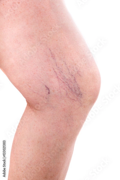 Obraz leg with spider veins