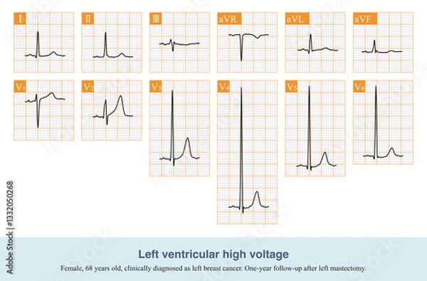 Obraz Simple left ventricular high voltage has no abnormalities such as left atrial abnormality, left axis deviation and ST-T change, but the amplitude of R wave in left chest lead is increased.
