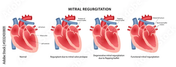 Obraz Mitral regurgitation, heart defect. Medical illustration of a healthy heart and pathological changes in the mitral valve. Vector illustration in a flat style