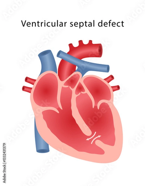 Obraz Ventricular septal defect, heart defect. Medical illustration of a diseased human heart. Vector illustration in a flat style.