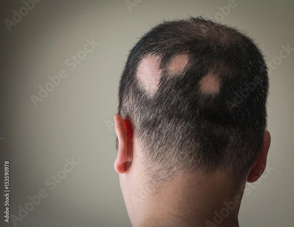 Obraz Alopecia Aerata