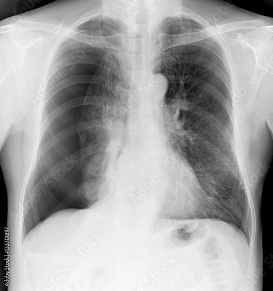 Fototapeta X-ray of the chest of a man with a pneumothorax