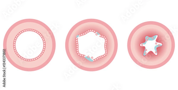 Obraz 健康な人の気道と喘息の人の気道