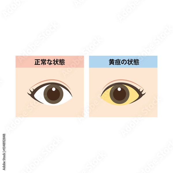 Obraz 正常な目と白目に黄疸が出ている目の比較イラスト