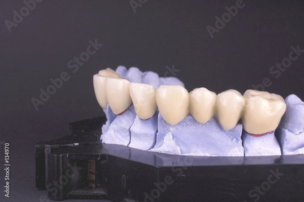 Obraz dental bridge