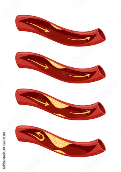 Fototapeta Atherosclerosis stage icon set. Anatomy of heart attack. Arteriosclerotic vascular disease or ASVD. Atherosclerotic plaque in coronary artery. illustration on white background