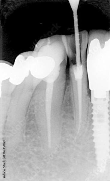 Obraz Root treatment and implant view
