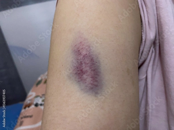 Fototapeta A close-up shot captures a dark purple bruise on a person's upper arm