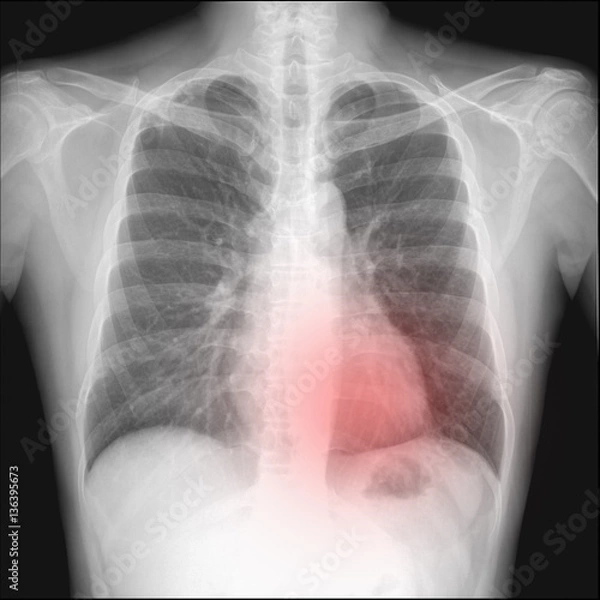 Fototapeta pneumothorax seen in chest radiography which want to intercostra
