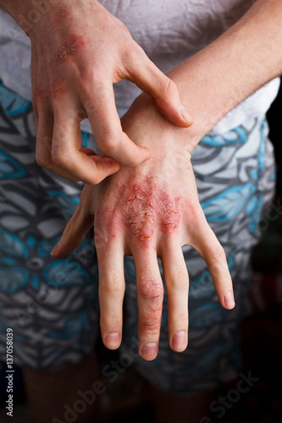 Obraz Closeup men itching and scratching by hand. Psoriasis or eczema on the hand. Atopic allergy skin with red spots