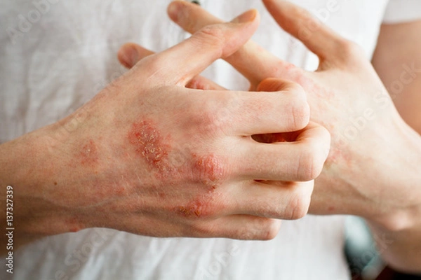 Fototapeta The problem with many people - eczema on hand. White background. Man itchind skin.