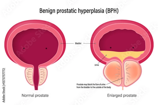 Fototapeta Benign prostatic hyperplasia (BPH). Comparison between normal prostate and enlarged prostate. Male reproductive system disease.
